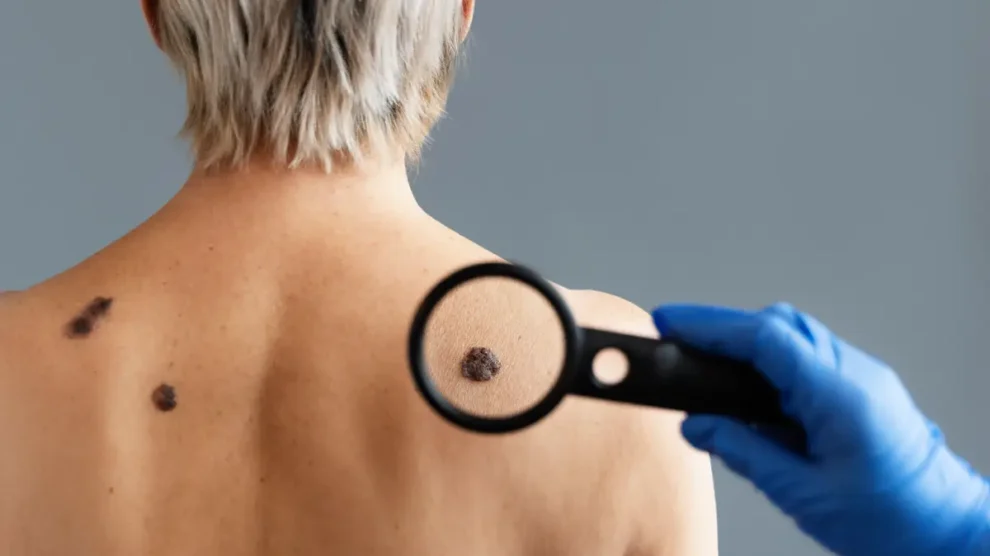 Câncer de pele – Conheça os principais tipos, exames e tratamentos