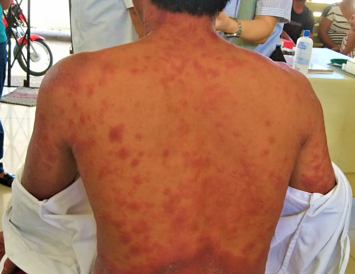 Janeiro Roxo: Conscientização e Combate à Hanseníase