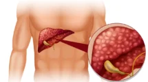 Hepatite: quando o fígado pede socorro silenciosamente